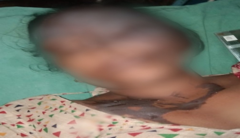Woman attacked with acid by a neighbourer at Mayakole in Nadia
